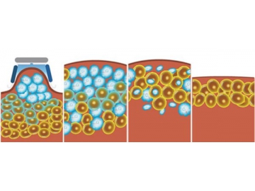 Criolipólisis/Crioterapia, Aparato de Adelgazamiento por Criolipólisis