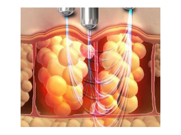 Aparatología Estética, Multifuncional - Elight Yag Láser Radiofrecuencia