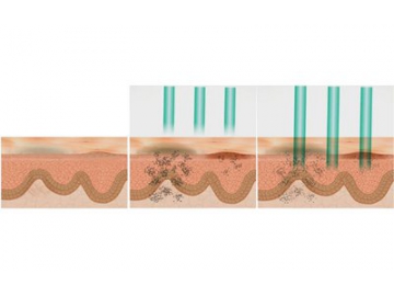 Aparatología Estética, Multifuncional - Elight Yag Láser Radiofrecuencia