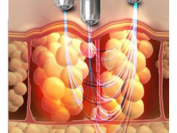 Aparatología Estética, Multifuncional - Cavitación Vacío Radiofrecuencia Láser