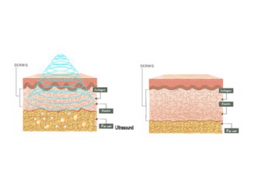 Aparatología Estética, Multifuncional - Cavitación Vacío Radiofrecuencia Láser